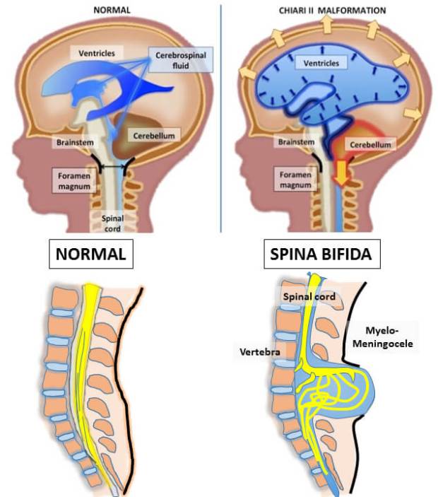 spina-bifida